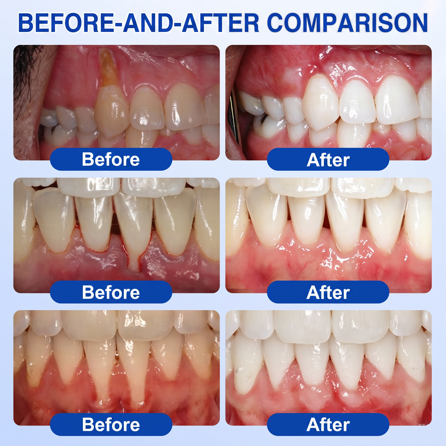 👨‍⚕️👨‍⚕️🦷❄️Solaroza® Gum Revive periodontal repair gel