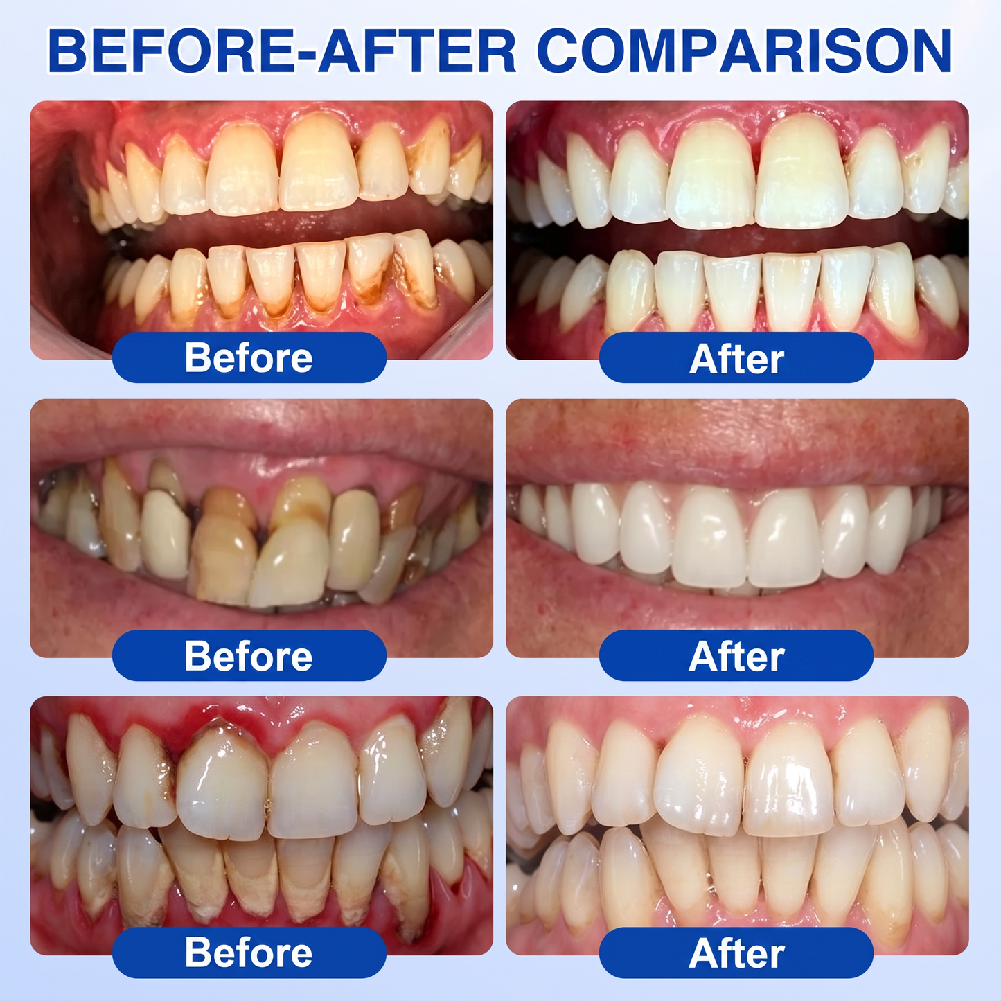 👨‍⚕️👨‍⚕️🦷❄️Solaroza® Gum Revive periodontal repair gel