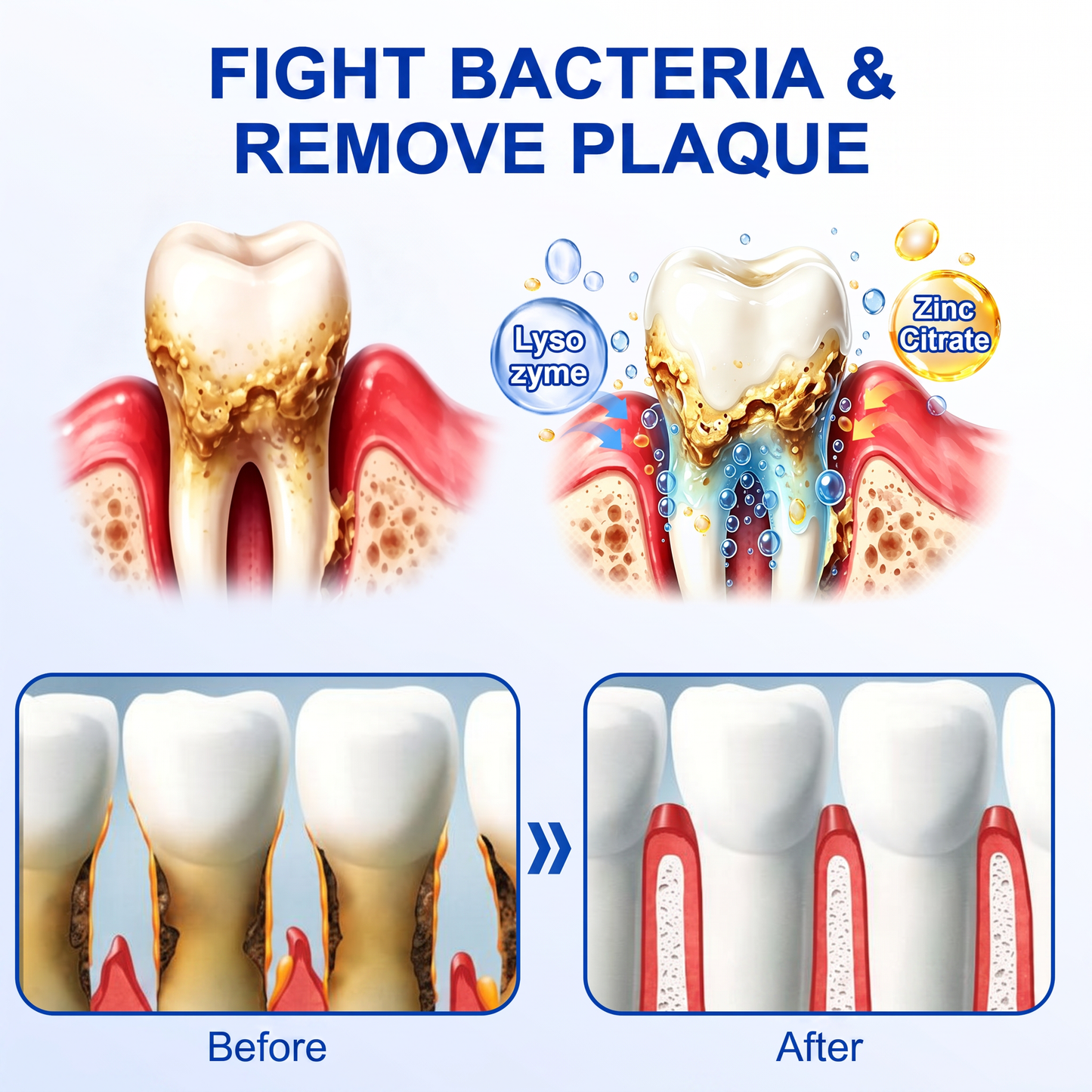 👨‍⚕️👨‍⚕️🦷❄️Solaroza® Gum Revive periodontal repair gel