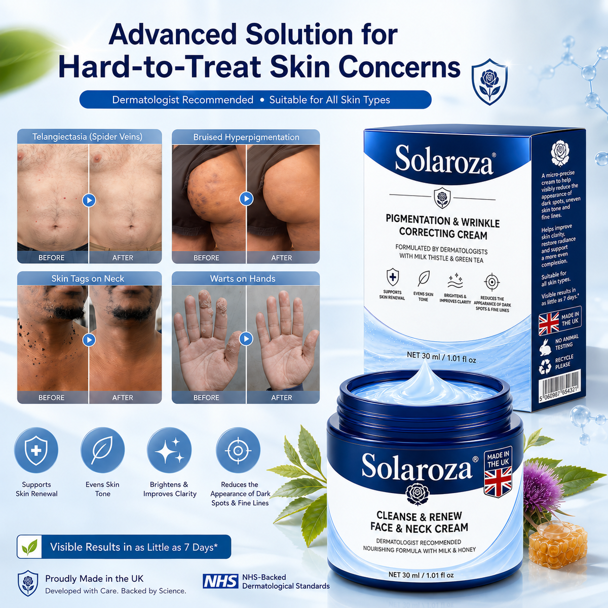💧𝐒𝐨𝐥𝐚𝐫𝐨𝐳𝐚® 7-Day Skin Tag & Pigmentation Removal Cream (Painless Formula – Scar-Free) 🇬🇧